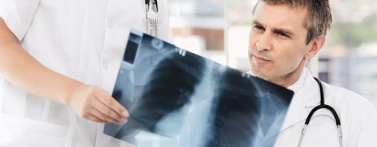 Articole/cancer pulmonar (1)