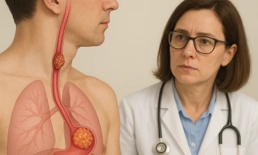 Diferențele între adenocarcinomul esofagian și carcinomul scuamos de esofag
