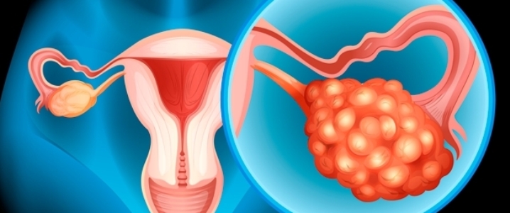 Articole/cancerul ovarian oncof