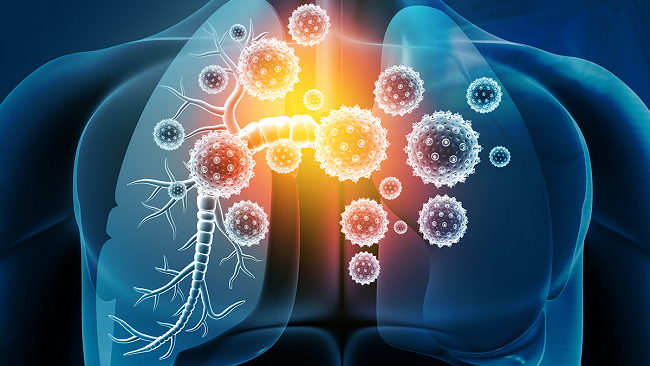 Articole/cancer-pulmonar-metastatic-OncoFort