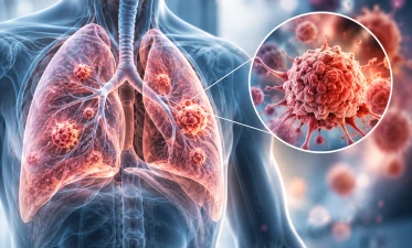 metastaze pulmonare cum apar