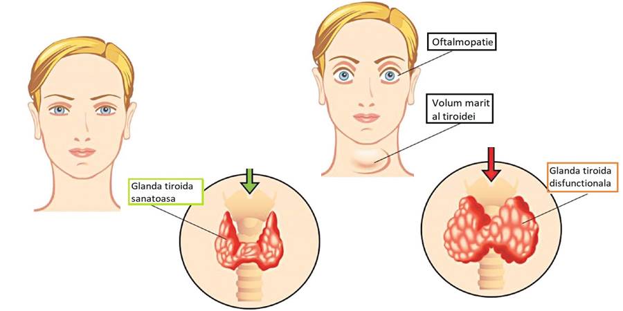 Hipertiroidismul: cauze, simptome, tratament