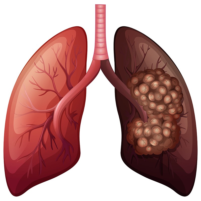 Cancer bronho-pulmonar diagnostic