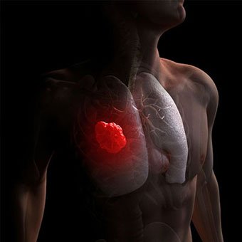 cancer bronhopulmonar OncoFort