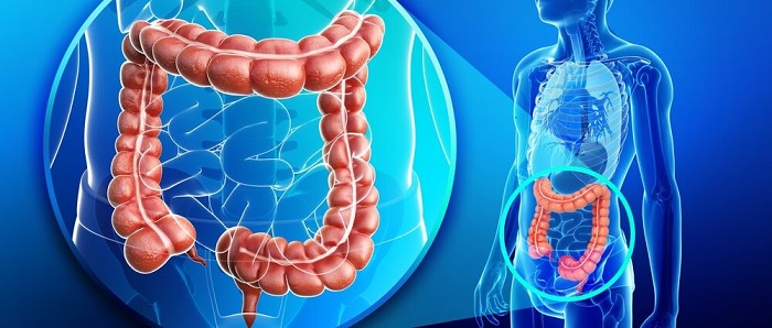 Cancerul de colon