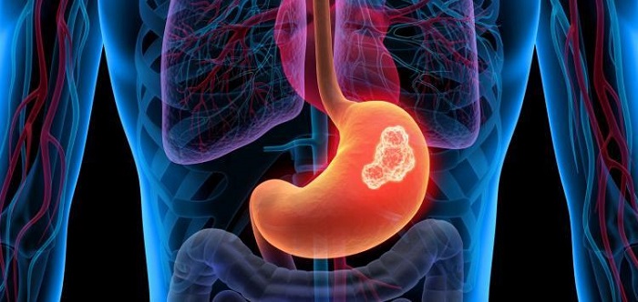 CANCERUL GASTRIC - preventie, simptome, factori de risc, investigatii si tratament