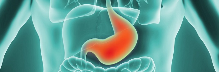 Neoplasm gastric stadiul IV (Prezentare caz)