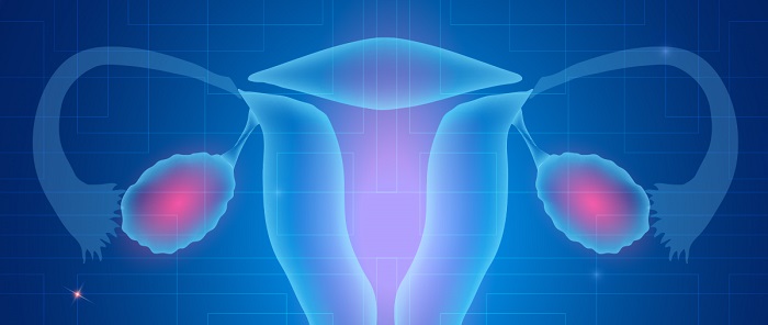 Tratament cancer ovarian - CAZ