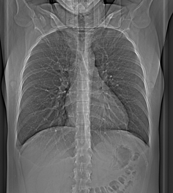 computer tomograf torace cancer pulmonar