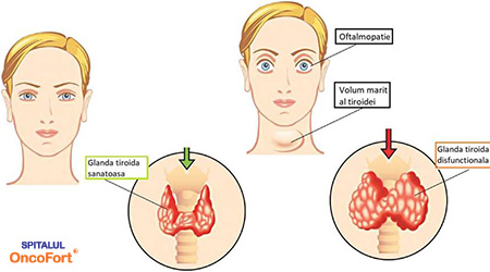 Radioterapia cu iod in boala Basedow Graves