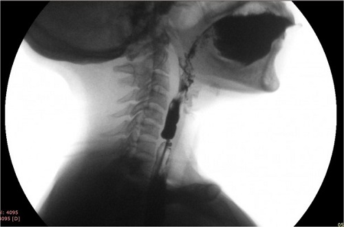 diagnostic cancer esofagian 