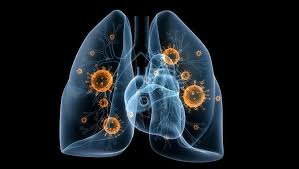 tratament cancer pulmonar metastatic