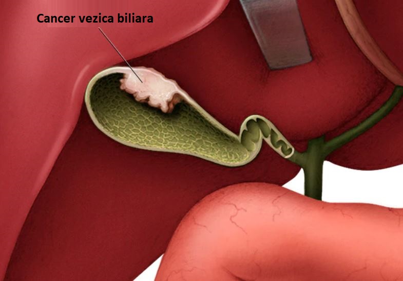 tumora vezica biliara